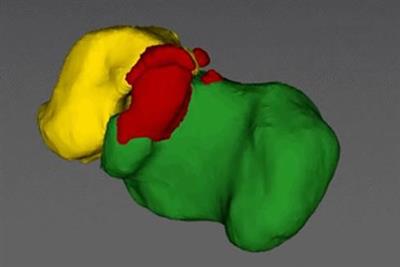 Application of mixed reality technology in talocalcaneal coalition resection